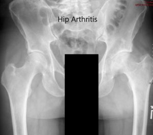 Radiografía preoperatoria de la pelvis que muestra la vista AP de la pelvis con ambas caderas