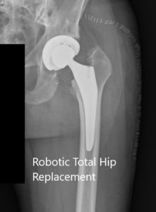 Radiografía postoperatoria de la cadera izquierda que muestra la AP y las vistas laterales