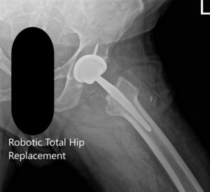 Postoperative X-ray of the left hip showing AP and frog-legged lateral view - img 2