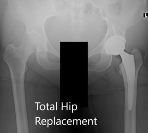 Postoperative X-ray of the pelvis showing AP and lateral views