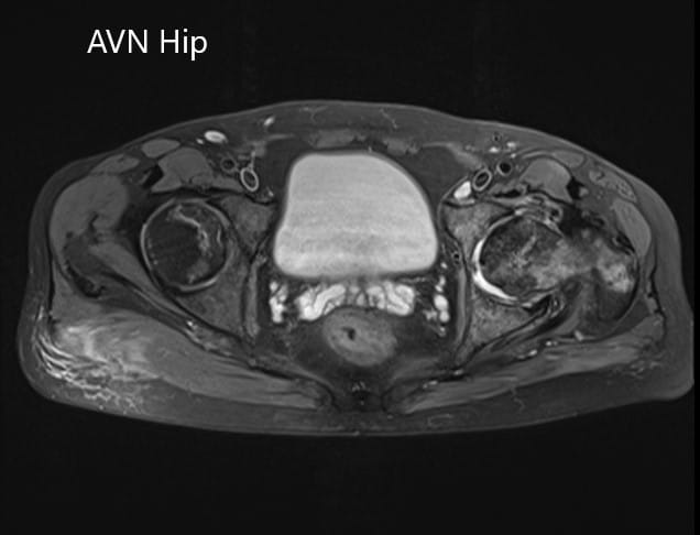 Sección axial de la T2WI de la pelvis