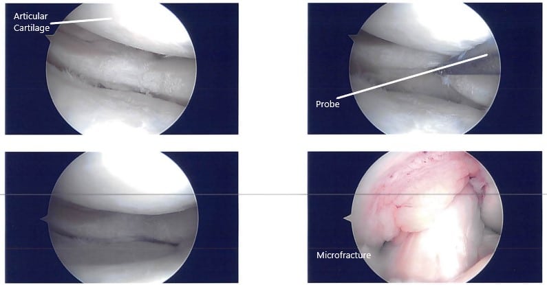 Intraoperative arthroscopic images 3