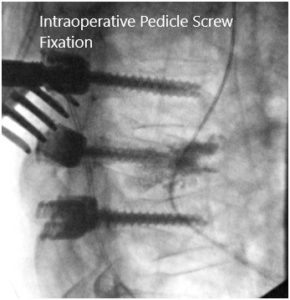 Intraoperative fluoroscopic images 3