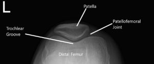 X-ray of the knee in AP and skyline view 2