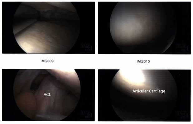 Intraoperative arthroscopic images 