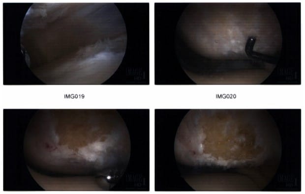 Intraoperative arthroscopic images 2