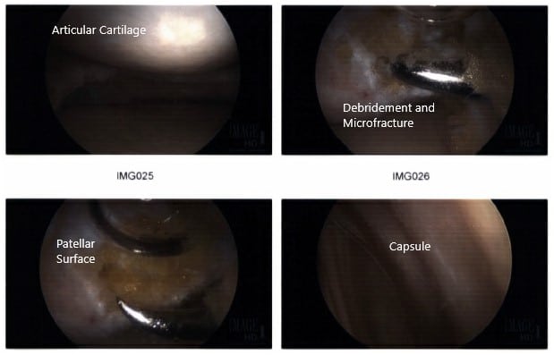 Intraoperative arthroscopic images 3