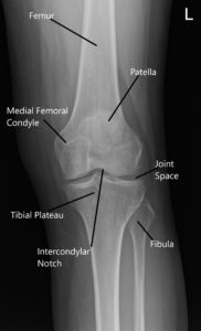 Radiografía de la rodilla izquierda en AP y vista del horizonte de la rótula