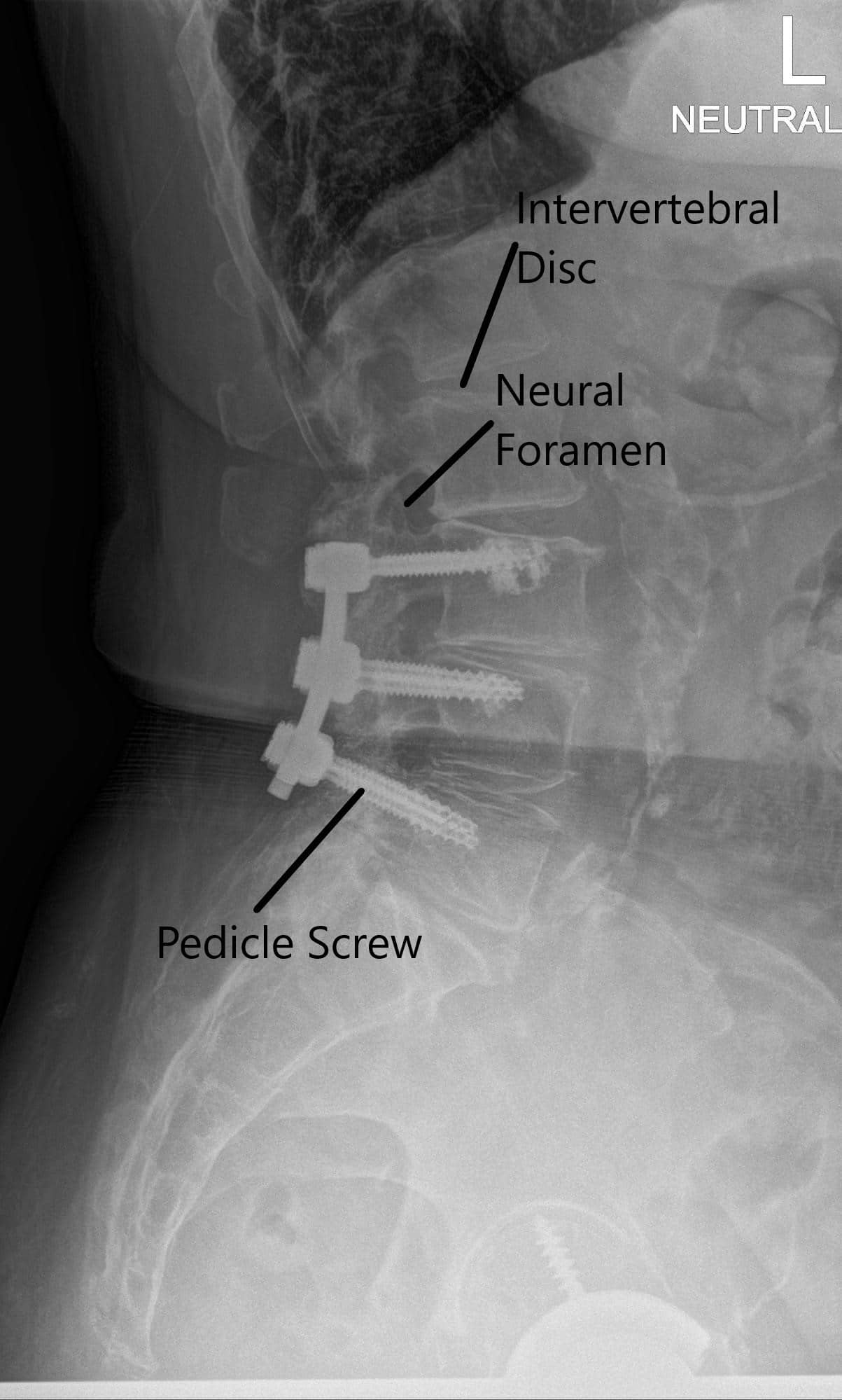 Radiografía de la columna vertebral LS en AP y vistas laterales 2