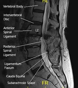 Resonancia magnética de la columna LS en la sección sagital