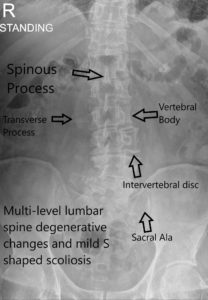 X-ray LS Spine AP view