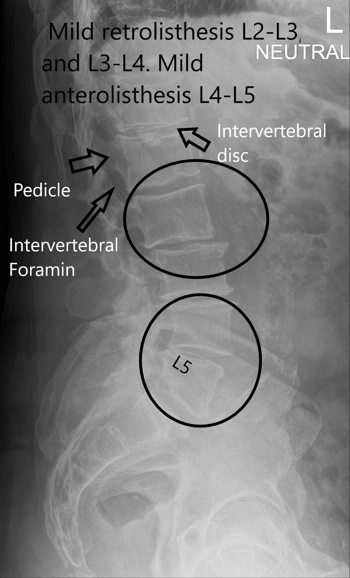 X-ray Lateral view of LS spine