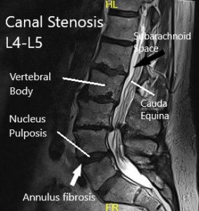 MRI of the lumbar spine