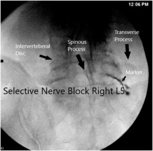 Intraoperative fluoroscopic image