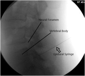 Intraoperative Fluoroscopy Images