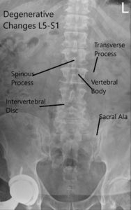 Preoperative X-ray LS spine in AP and Lateral Views