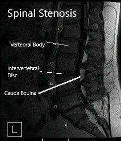 MRI showing sagittal and axial sections