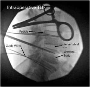 Intraoperative Fluoroscopic Images