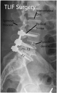 Postoperative X-ray in AP and Lateral views 2