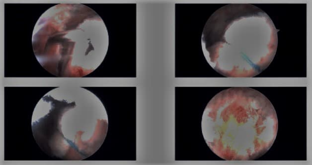 Intraoperative arthroscopic images