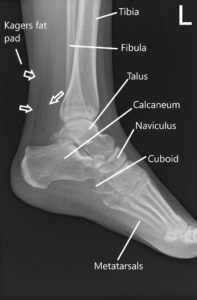 X-ray showing the normal soft tissue shadow of Achilles tendon.