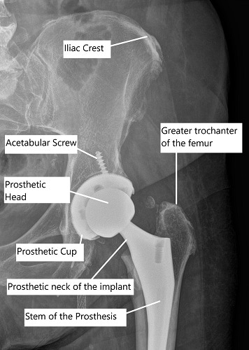 Radiografía que muestra el reemplazo total de cadera asistido por robot.