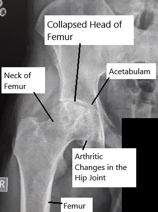 Radiografía que muestra necrosis avascular de la articulación de la cadera