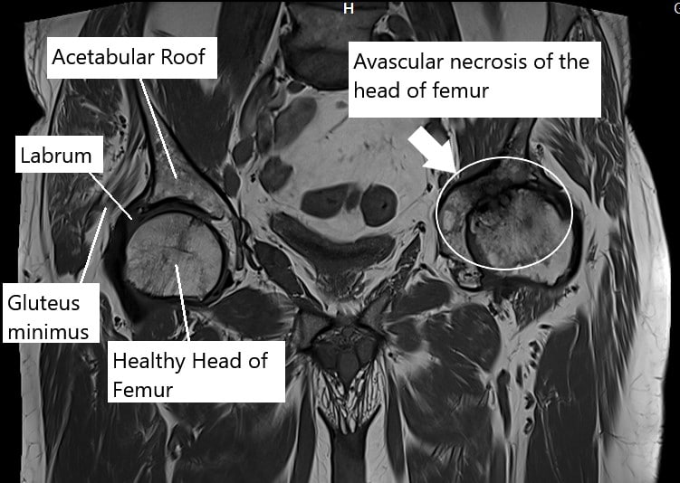 MRI showing AVN hip