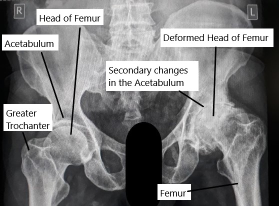 Radiografía que muestra necrosis avascular (AVN) de la cadera