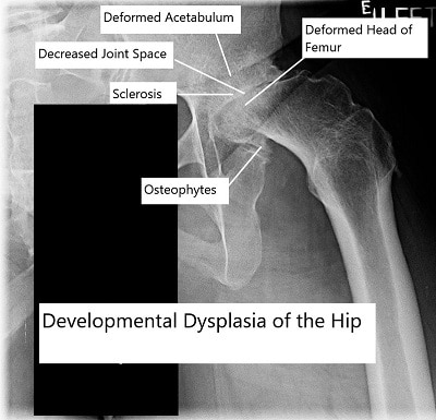 Developemental dysplasia