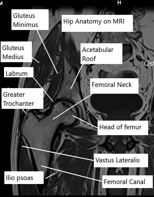 MRI of the hip joint showing various structures