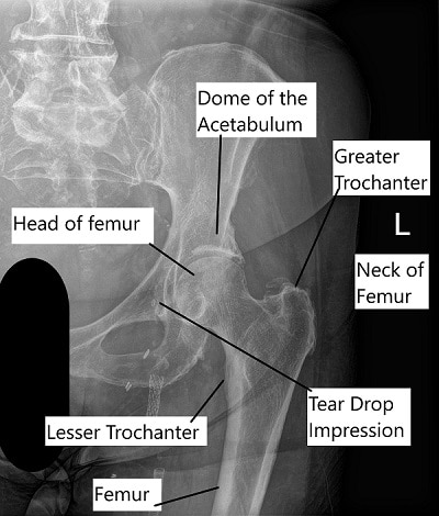 X-ray showing hip anatomy.