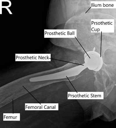 Total Hip Replacement on X-ray in frog legged lateral view.