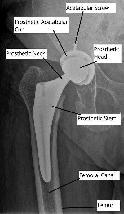 X-ray showing Total Hip Replacement in AP view.