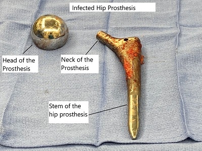 Revision Hip Replacement