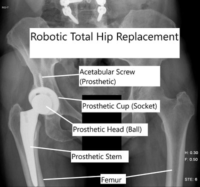 Robotic hip replacement