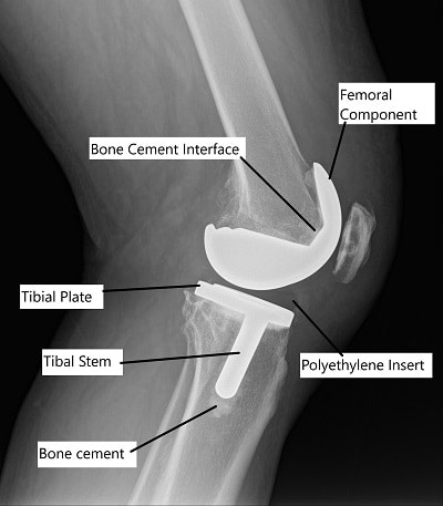 Cemented TKA