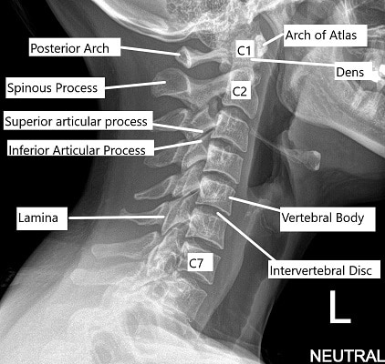 X-ray of the cervical spine