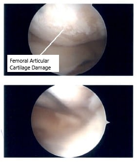 Arthroscopic image showing articular cartilage damage.