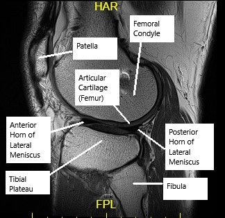 MRI of the knee showing articular cartilage.