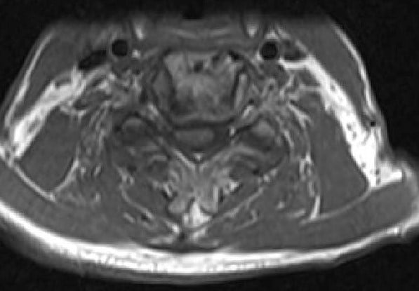 Imagen de resonancia magnética T2 Corte axial que muestra estenosis y compresión graves de la médula espinal en C3-4 2
