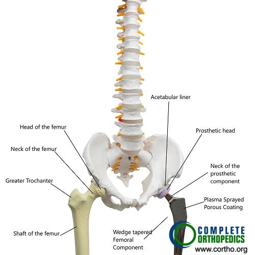 Total Hip Replacement