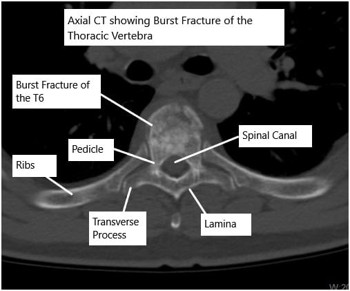 CT scan of the thoracic spine showing a burst fracture of the T6 vertebra