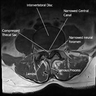 Axial section of the lumbar spine showing spinal stenosis and the lamina.