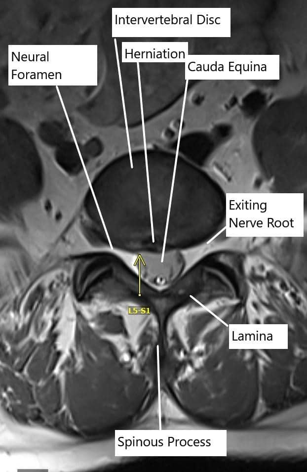 Axial section of the spine showing central disc herniation.