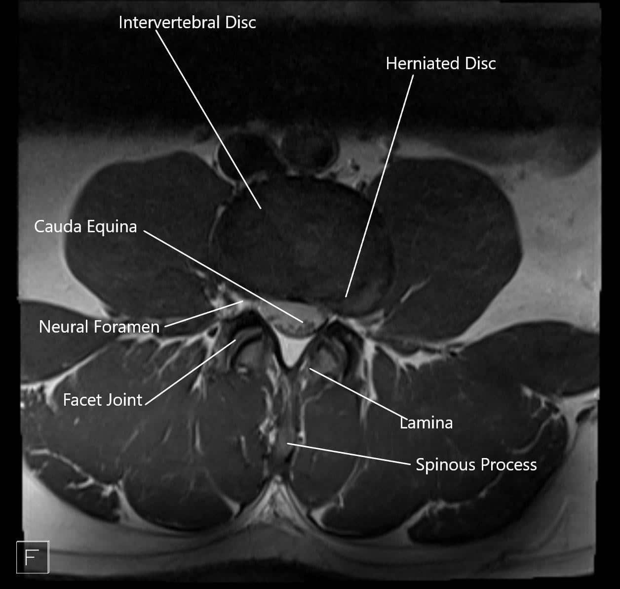 MRI showing herniated disc in axial section.