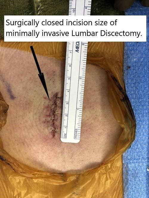 Intraoperative image showing the surgical incision size of minimally invasive lumbar discectomy.