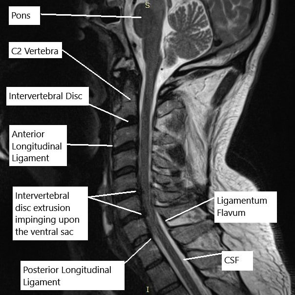 Resonancia magnética de la columna cervical en la sección sagital.