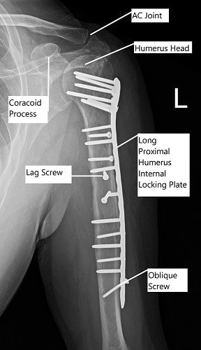 Post-operative x-ray of the left shoulder in AP view.