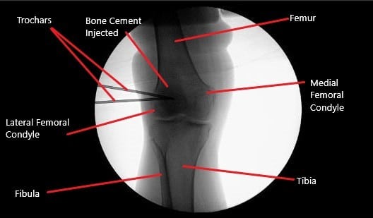 Intraoperative fluoroscopic image of the right knee showing tricalcium phosphate bone injection.